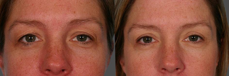 Eyelid Surgery (Blepharoplasty) Before & After Gallery - Patient 758762 - Image 2
