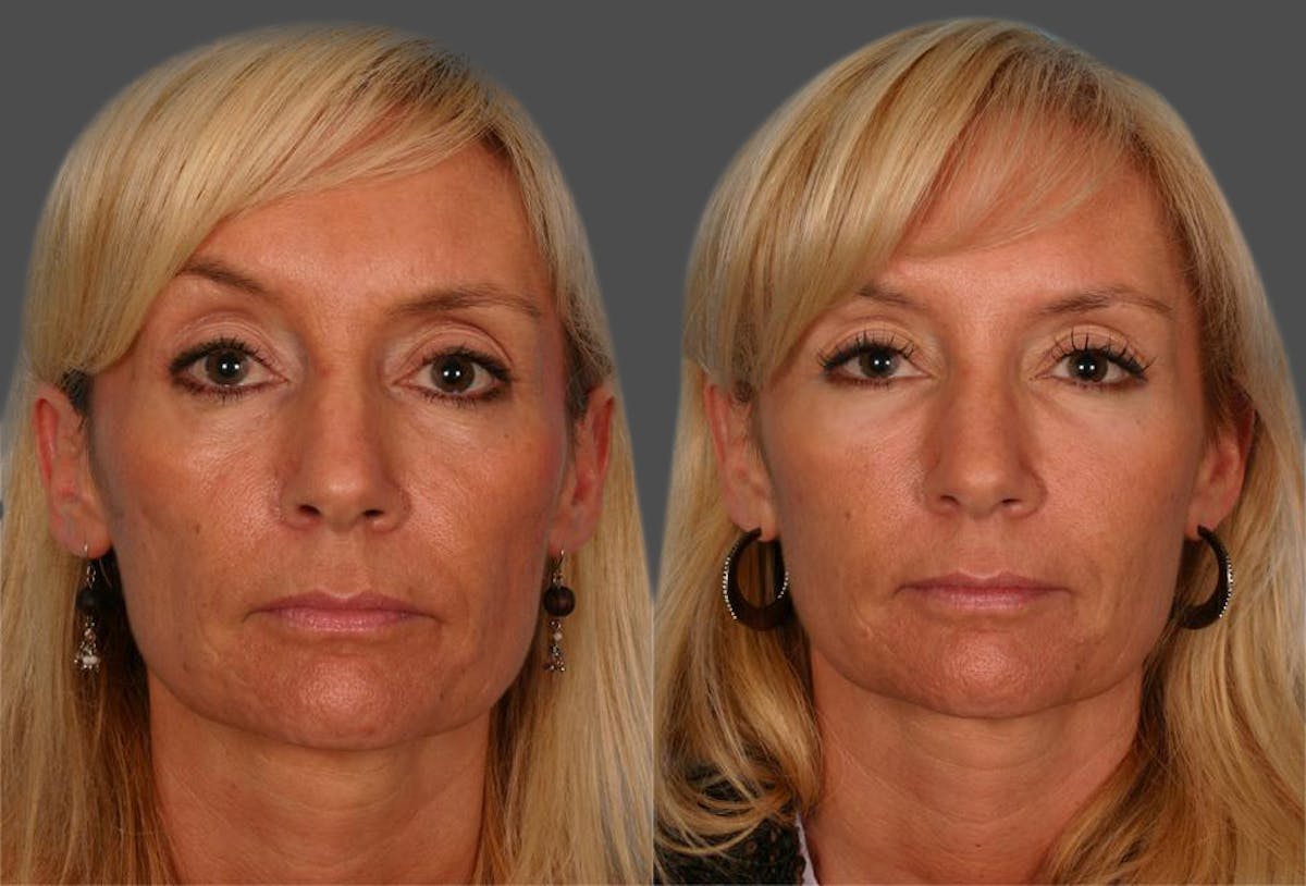 Facial Fat Transfer Before & After Gallery - Patient 418701 - Image 1
