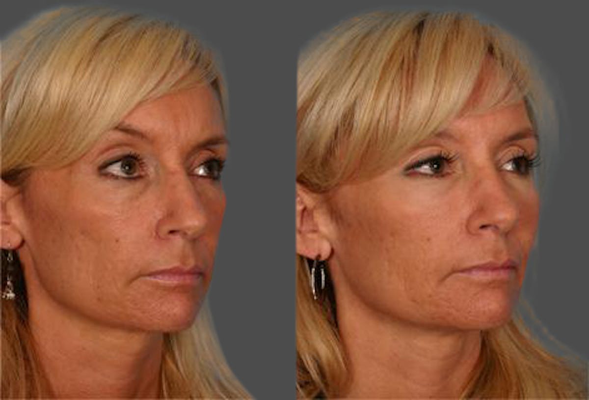 Facial Fat Transfer Before & After Gallery - Patient 418701 - Image 2