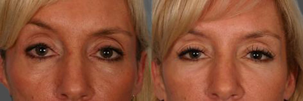 Facial Fat Transfer Before & After Gallery - Patient 418701 - Image 3