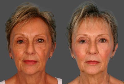 Eyelid Surgery (Blepharoplasty) Before & After Gallery - Patient 561507 - Image 1