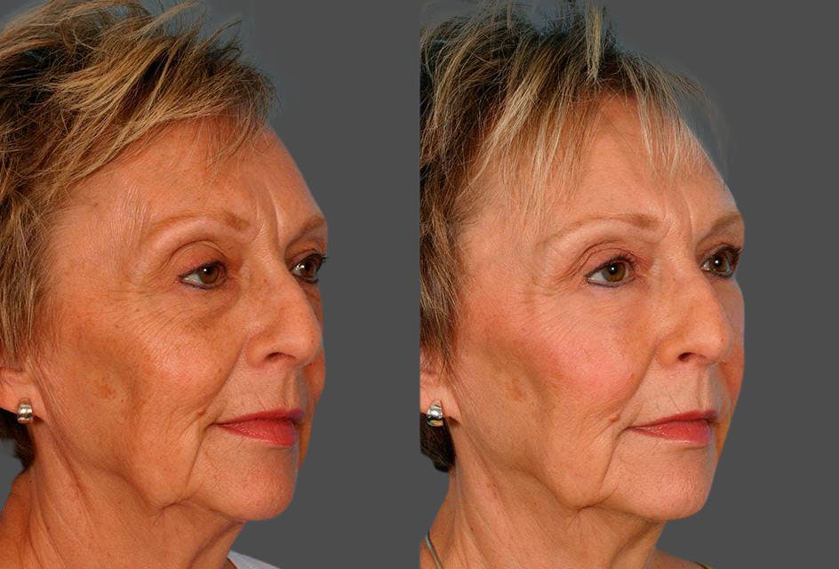 Eyelid Surgery (Blepharoplasty) Before & After Gallery - Patient 561507 - Image 2