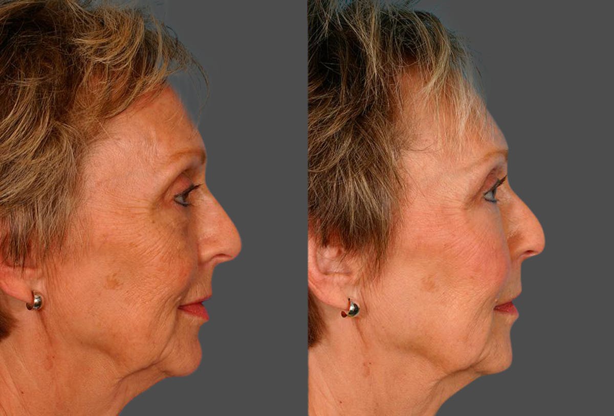 Eyelid Surgery (Blepharoplasty) Before & After Gallery - Patient 561507 - Image 3