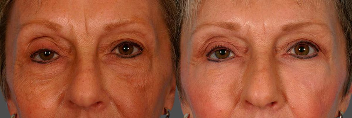 Eyelid Surgery (Blepharoplasty) Before & After Gallery - Patient 561507 - Image 4