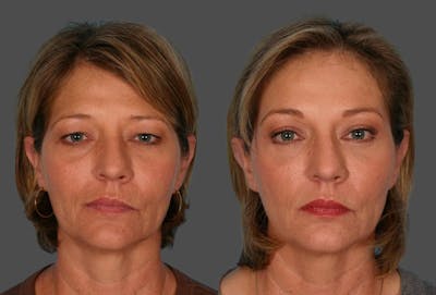 Eyelid Surgery (Blepharoplasty) Before & After Gallery - Patient 465089 - Image 1