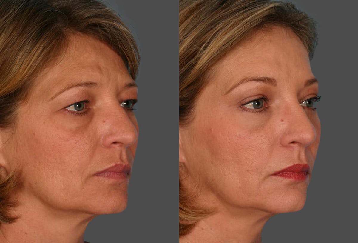 Eyelid Surgery (Blepharoplasty) Before & After Gallery - Patient 465089 - Image 2