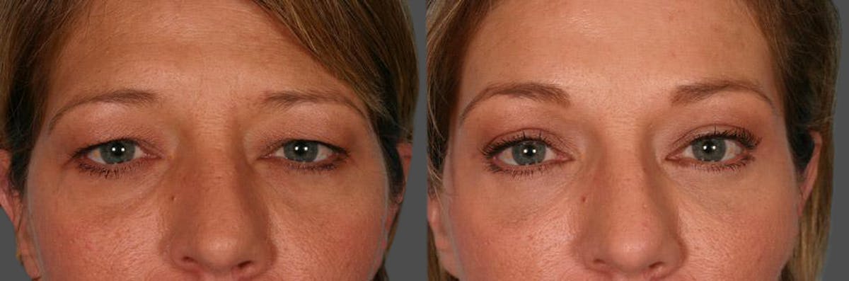 Eyelid Surgery (Blepharoplasty) Before & After Gallery - Patient 465089 - Image 4