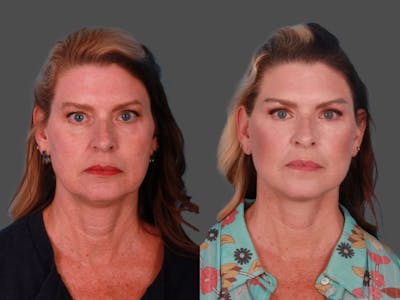 Eyelid Surgery (Blepharoplasty) Before & After Gallery - Patient 420028 - Image 1
