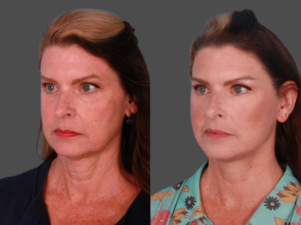 Eyelid Surgery (Blepharoplasty) Before & After Gallery - Patient 420028 - Image 2