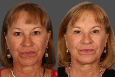 Eyelid Surgery (Blepharoplasty) Before & After Gallery - Patient 403639 - Image 1