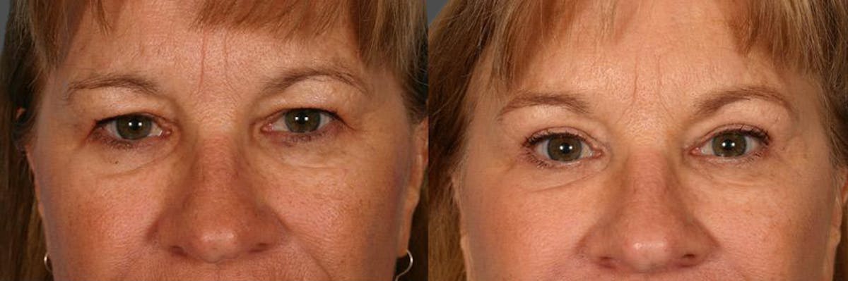 Eyelid Surgery (Blepharoplasty) Before & After Gallery - Patient 403639 - Image 2