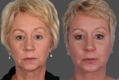 Eyelid Surgery (Blepharoplasty) Before & After Gallery - Patient 397661 - Image 1