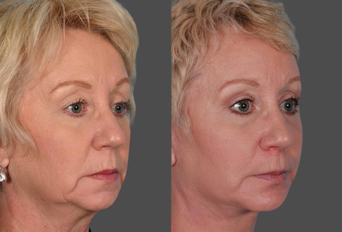 Eyelid Surgery (Blepharoplasty) Before & After Gallery - Patient 397661 - Image 2