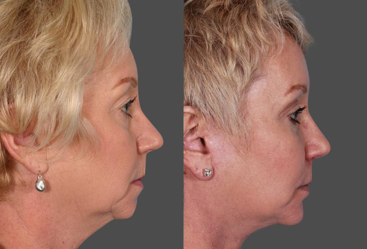 Eyelid Surgery (Blepharoplasty) Before & After Gallery - Patient 397661 - Image 3