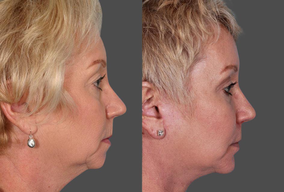 Eyelid Surgery (Blepharoplasty) Before & After Gallery - Patient 397661 - Image 3