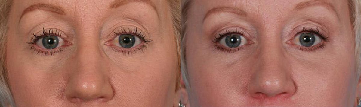 Eyelid Surgery (Blepharoplasty) Before & After Gallery - Patient 397661 - Image 4