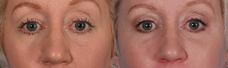 Eyelid Surgery (Blepharoplasty) Before & After Gallery - Patient 397661 - Image 4