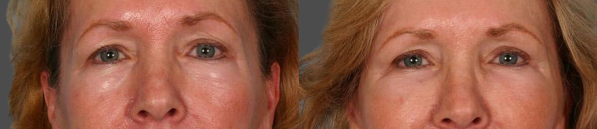 Eyelid Surgery (Blepharoplasty) Before & After Gallery - Patient 387661 - Image 1