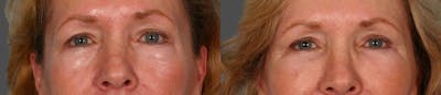 Eyelid Surgery (Blepharoplasty) Before & After Gallery - Patient 387661 - Image 1