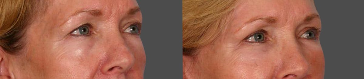 Eyelid Surgery (Blepharoplasty) Before & After Gallery - Patient 387661 - Image 2