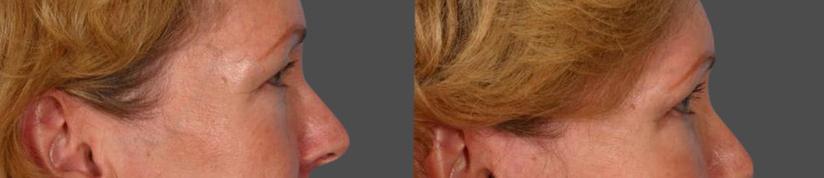 Eyelid Surgery (Blepharoplasty) Before & After Gallery - Patient 387661 - Image 3