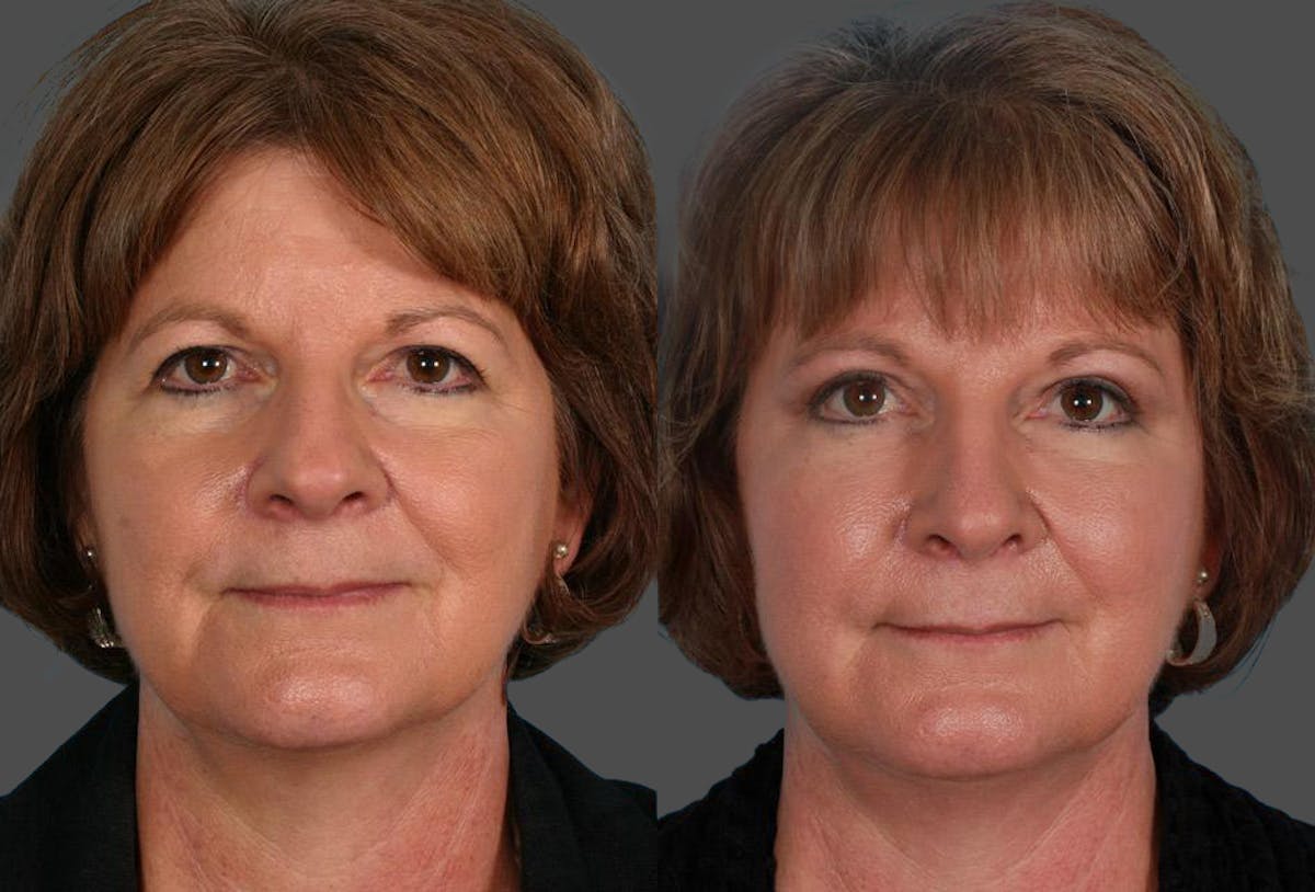Facial Fat Transfer Before & After Gallery - Patient 330523 - Image 1