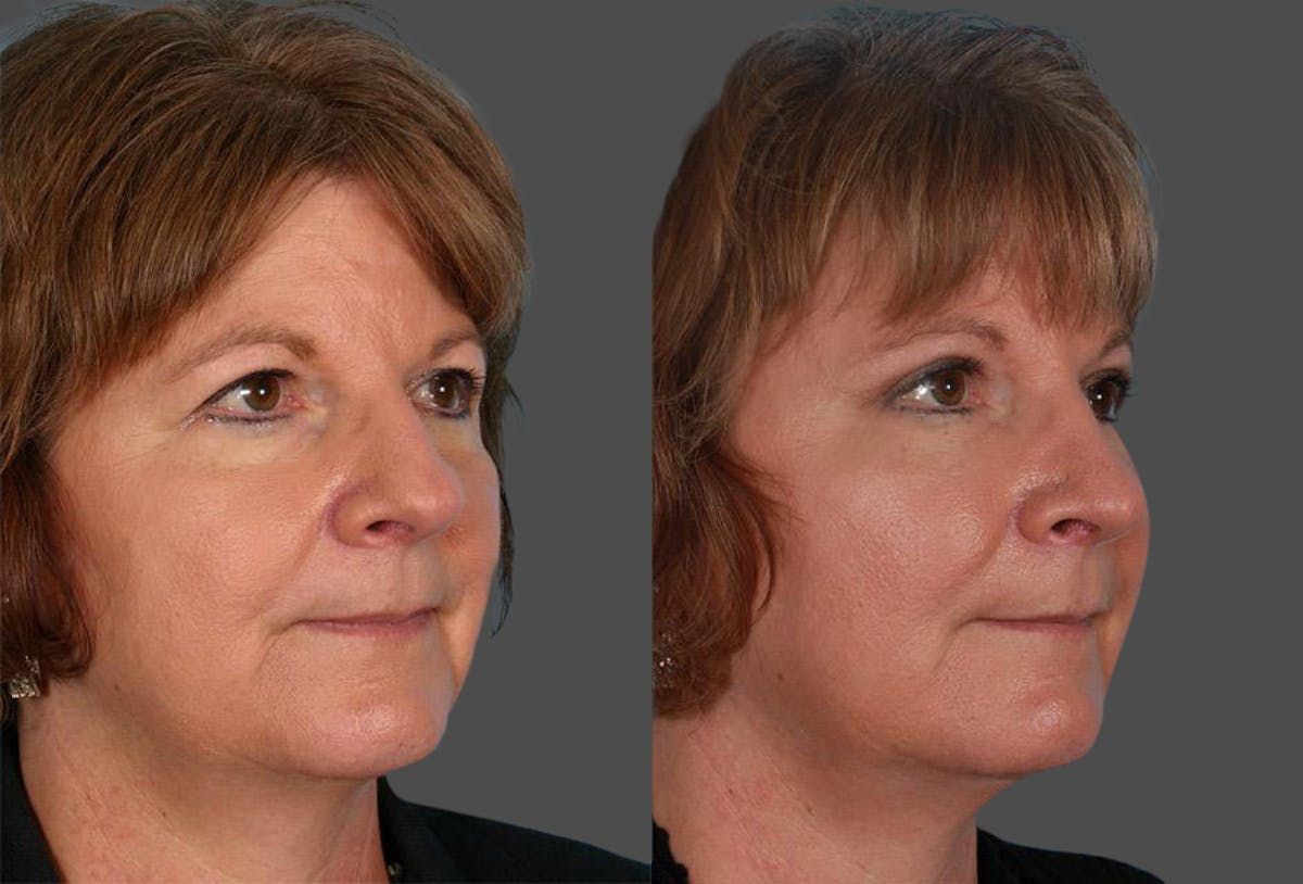 Facial Fat Transfer Before & After Gallery - Patient 330523 - Image 2