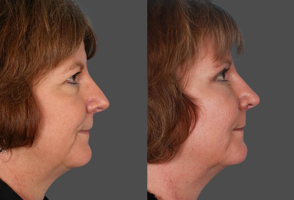Facial Fat Transfer Before & After Gallery - Patient 330523 - Image 3