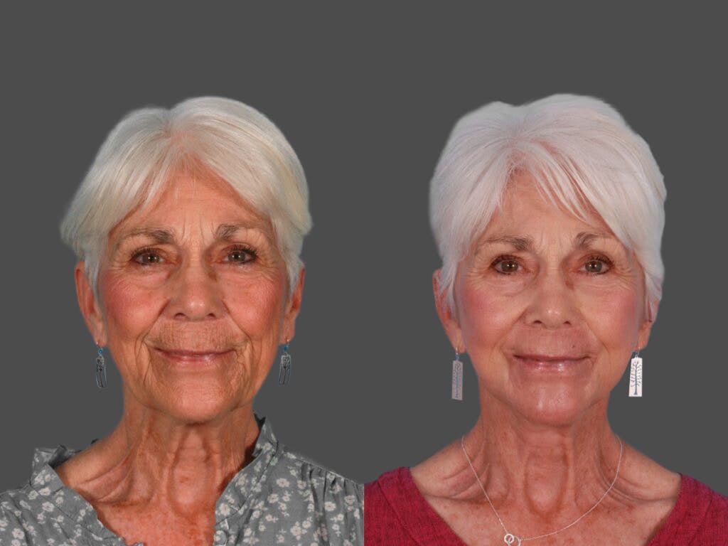 TCA Peel / Dermabrasion Before & After Gallery - Patient 292619 - Image 1