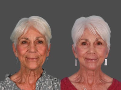 Eyelid Surgery (Blepharoplasty) Before & After Gallery - Patient 374606 - Image 1