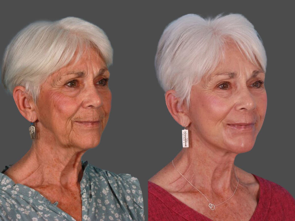 TCA Peel / Dermabrasion Before & After Gallery - Patient 292619 - Image 2
