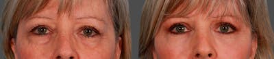 Eyelid Surgery (Blepharoplasty) Before & After Gallery - Patient 371690 - Image 1