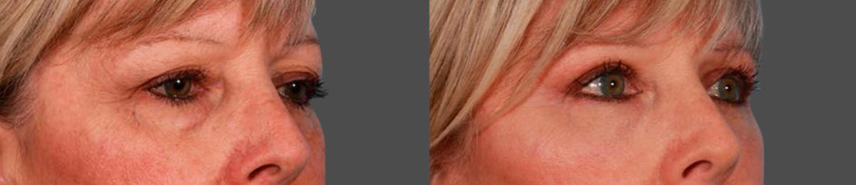 Eyelid Surgery (Blepharoplasty) Before & After Gallery - Patient 371690 - Image 2