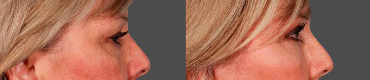 Eyelid Surgery (Blepharoplasty) Before & After Gallery - Patient 371690 - Image 3