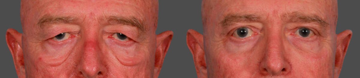 Eyelid Surgery (Blepharoplasty) Before & After Gallery - Patient 352426 - Image 1