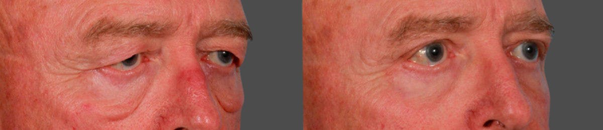 Eyelid Surgery (Blepharoplasty) Before & After Gallery - Patient 352426 - Image 2
