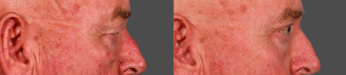 Eyelid Surgery (Blepharoplasty) Before & After Gallery - Patient 352426 - Image 3