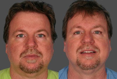 Eyelid Surgery (Blepharoplasty) Before & After Gallery - Patient 351271 - Image 1