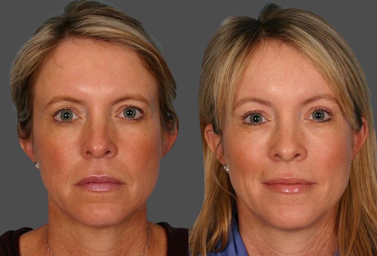 Eyelid Surgery (Blepharoplasty) Before & After Gallery - Patient 348736 - Image 1