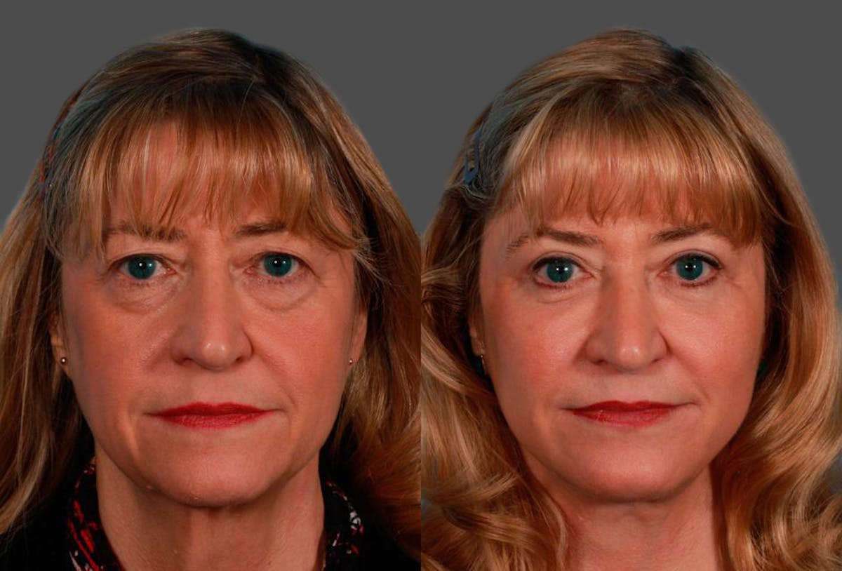 Eyelid Surgery (Blepharoplasty) Before & After Gallery - Patient 337553 - Image 1