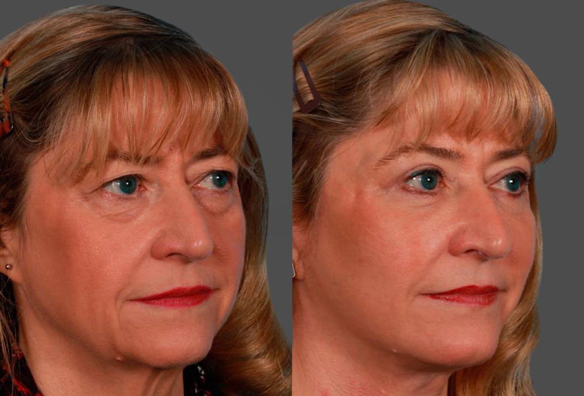 Eyelid Surgery (Blepharoplasty) Before & After Gallery - Patient 337553 - Image 2
