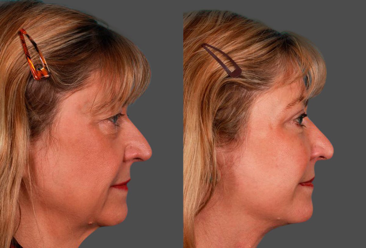Eyelid Surgery (Blepharoplasty) Before & After Gallery - Patient 337553 - Image 3