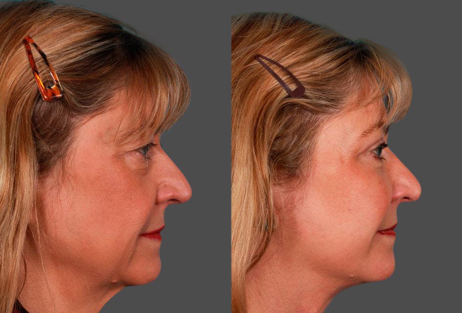 Eyelid Surgery (Blepharoplasty) Before & After Gallery - Patient 337553 - Image 3