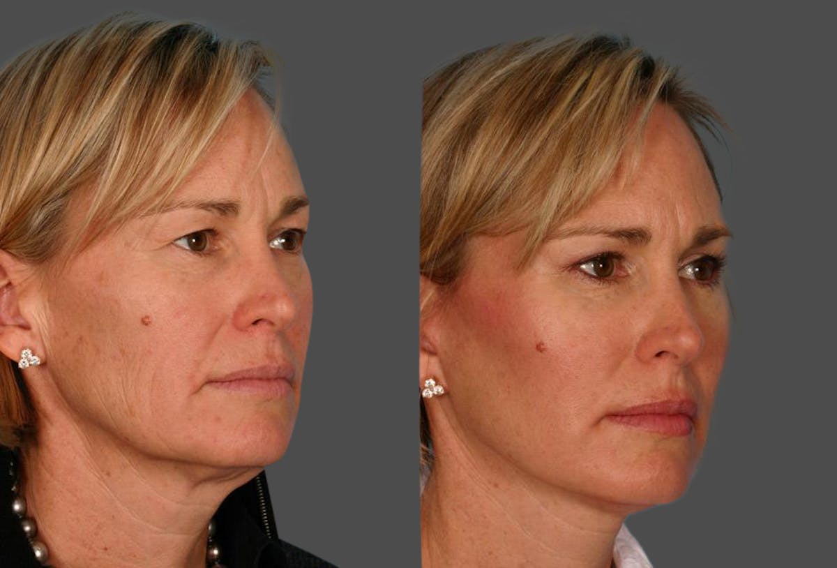 Limited Incision Facelift Before & After Gallery - Patient 353902 - Image 2