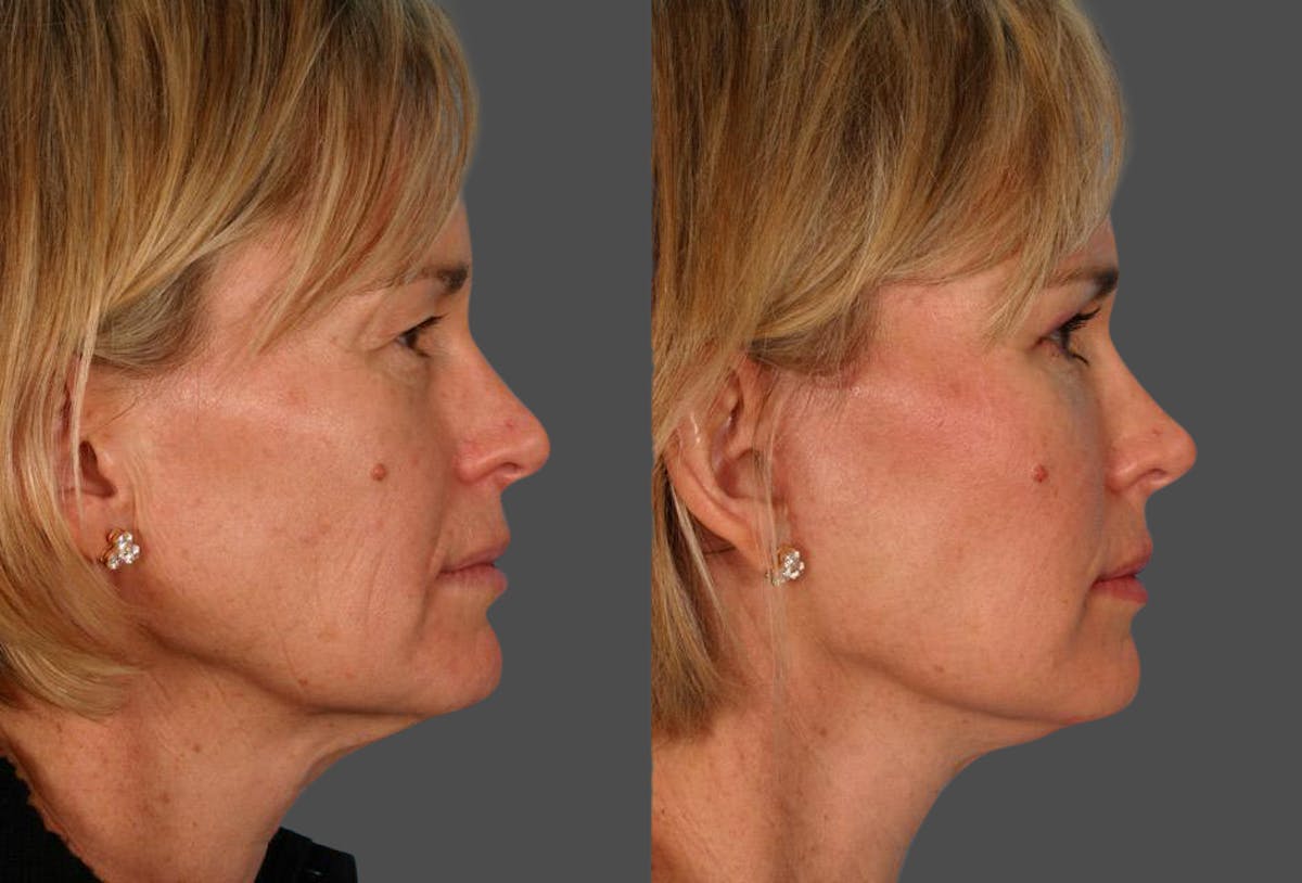Limited Incision Facelift Before & After Gallery - Patient 353902 - Image 3