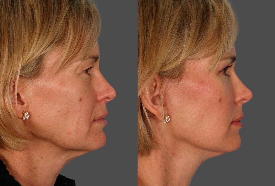 Limited Incision Facelift Before & After Gallery - Patient 353902 - Image 3