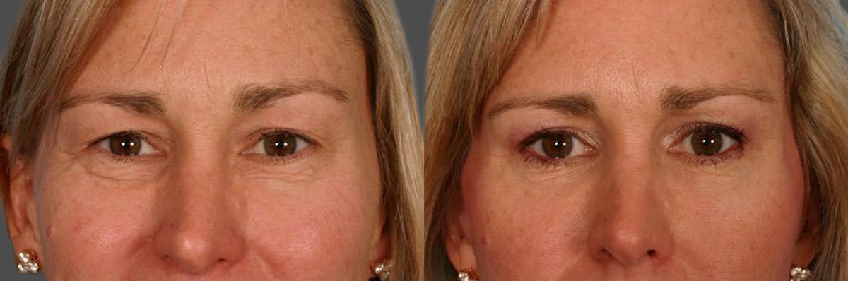 Limited Incision Facelift Before & After Gallery - Patient 353902 - Image 4