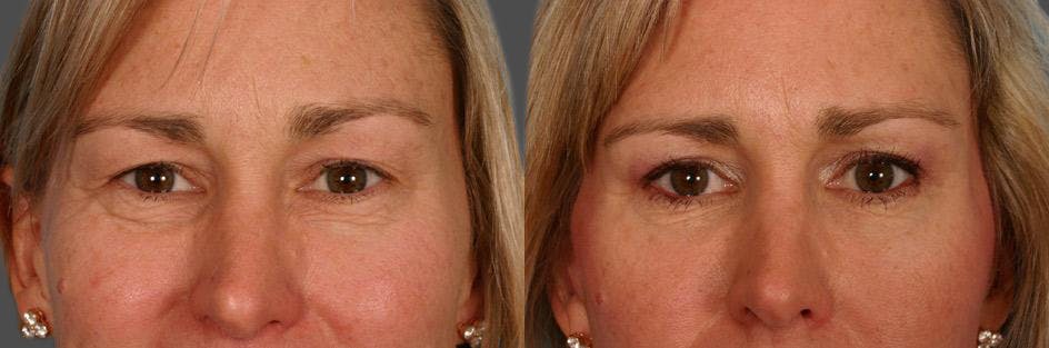 Limited Incision Facelift Before & After Gallery - Patient 353902 - Image 4