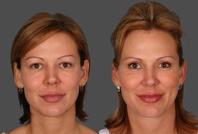 Eyelid Surgery (Blepharoplasty) Before & After Gallery - Patient 334441 - Image 1