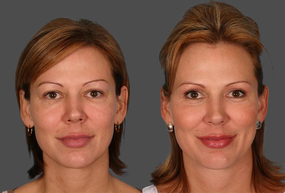 Eyelid Surgery (Blepharoplasty) Before & After Gallery - Patient 334441 - Image 1